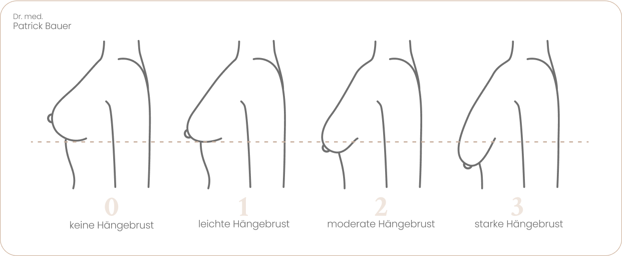 haengebrust schwergrade dr bauer